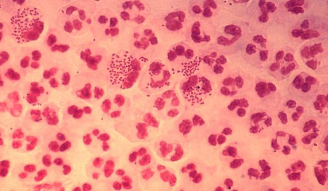 Antibiotic-resistant gonorrhea is on the rise: World Health Organization