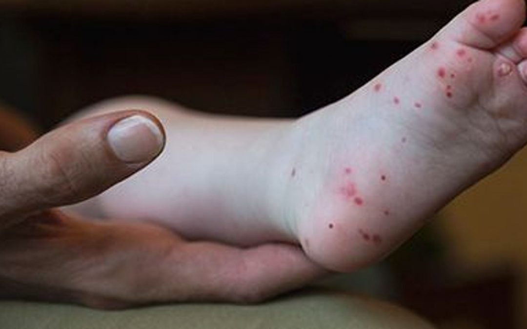Hand, foot and mouth disease in kids: Symptoms, treatment, prevention