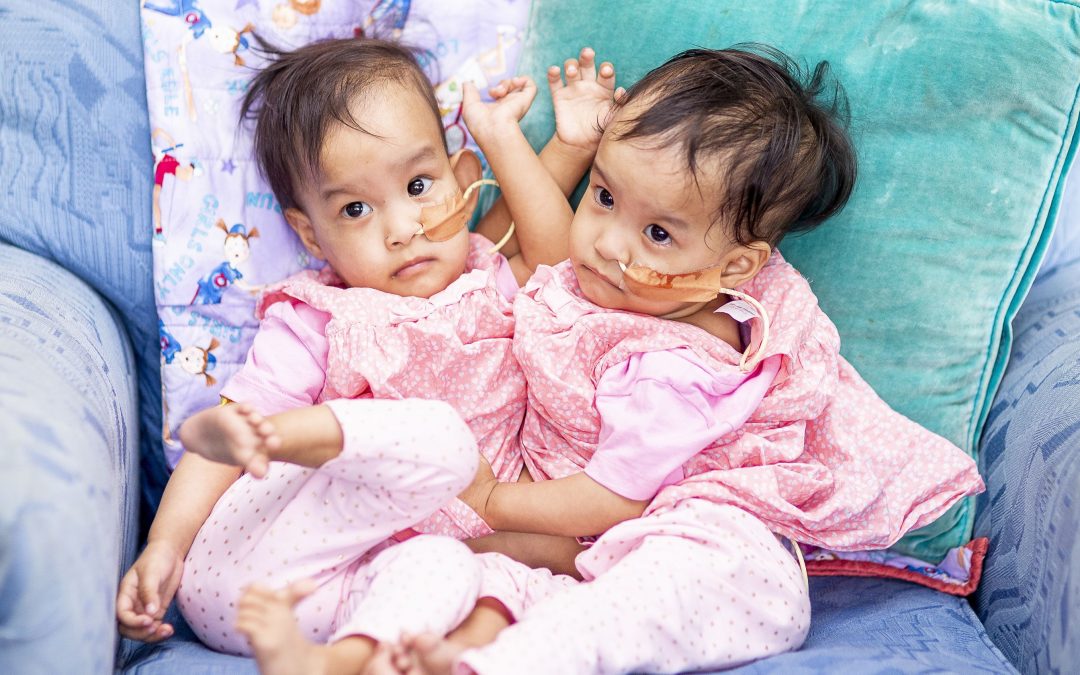 Conjoined twin babies separated after six-hour surgery in Australia