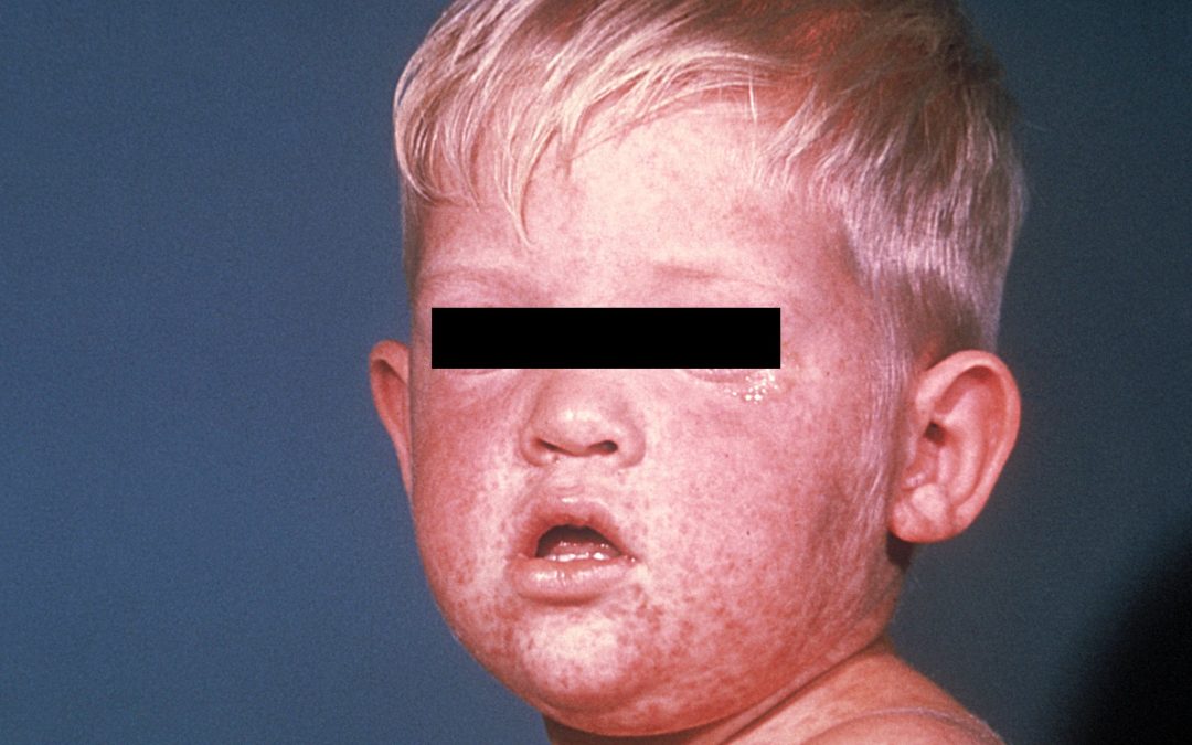 Mumps, Measles, Rubella signs, symptoms, information